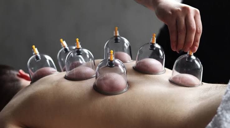 Clinical Quantum Cupping Therapy